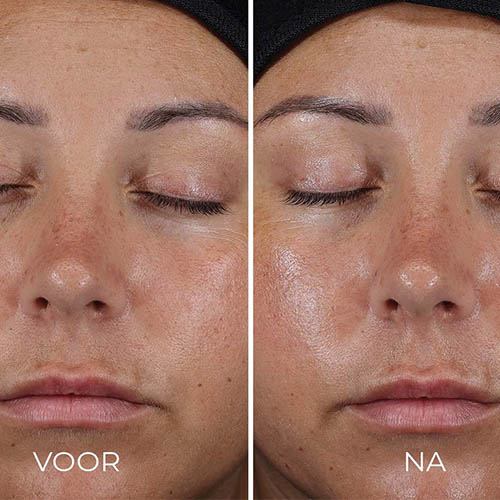 voor-en-na-Daily-Prevention-Ultra-Defence-Moisturizer