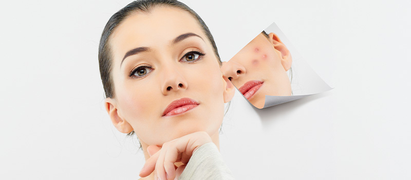 NikkieTutorials vertelt: Peeling van je gezicht thuis na de zomer