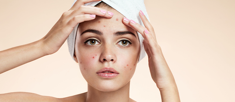 NikkieTutorials vertelt: Last van acne? Zo kom je er vanaf!